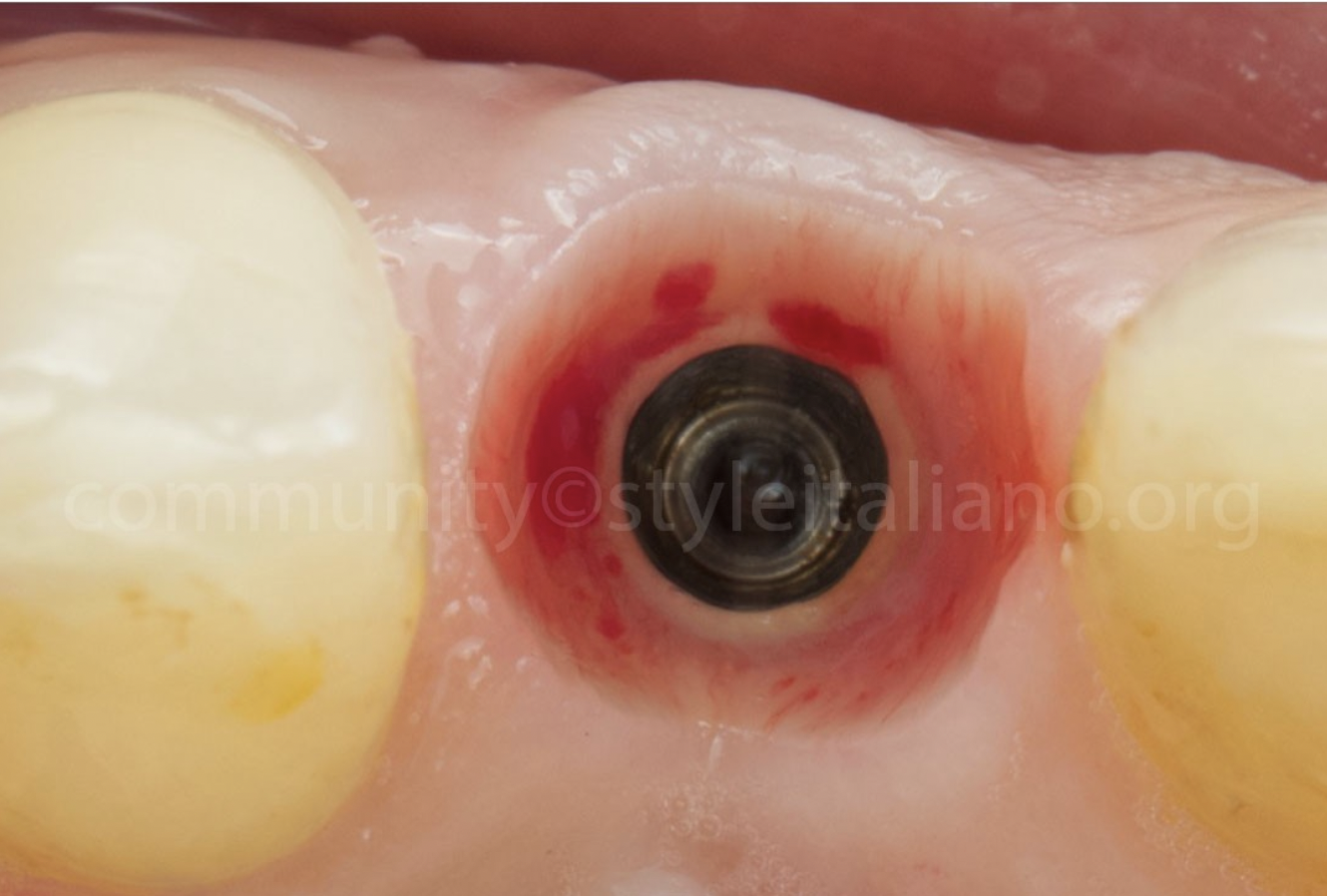 Điều Trị Lại Một Mão Răng Trên Implant: Tối ưu hoá kết quả bằng phần mềm OptiShade